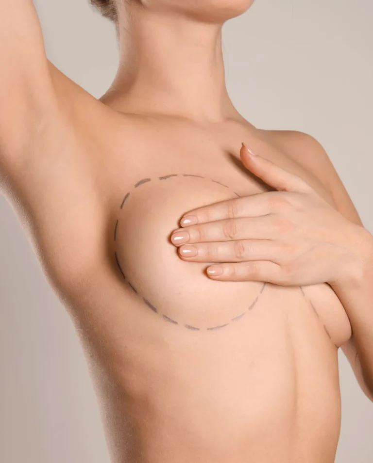 Mastoplastica Additiva