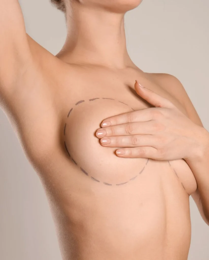 Mastoplastica Additiva